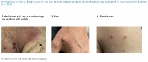 Newswise: Community Transmission of Monkeypox