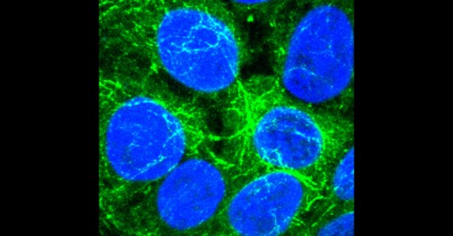 Newswise: New Cancer Therapy Target Stops Tumor Cells From Sharing Resources