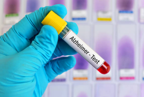Newswise: Blood Test Appears Promising In Diagnosing Alzheimer’s Disease Before Onset of Symptoms, Could Show Promise In Early Intervention Treatments