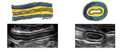 Newswise: A New Ultrasound Technology is Revolutionizing IBD Care at UNC School of Medicine