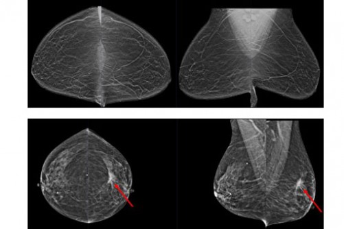 Newswise: AI-assisted breast-cancer screening may reduce unnecessary testing